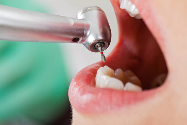 Best Emergency Dental Care for Broken or Chipped Teeth in Florin, CA